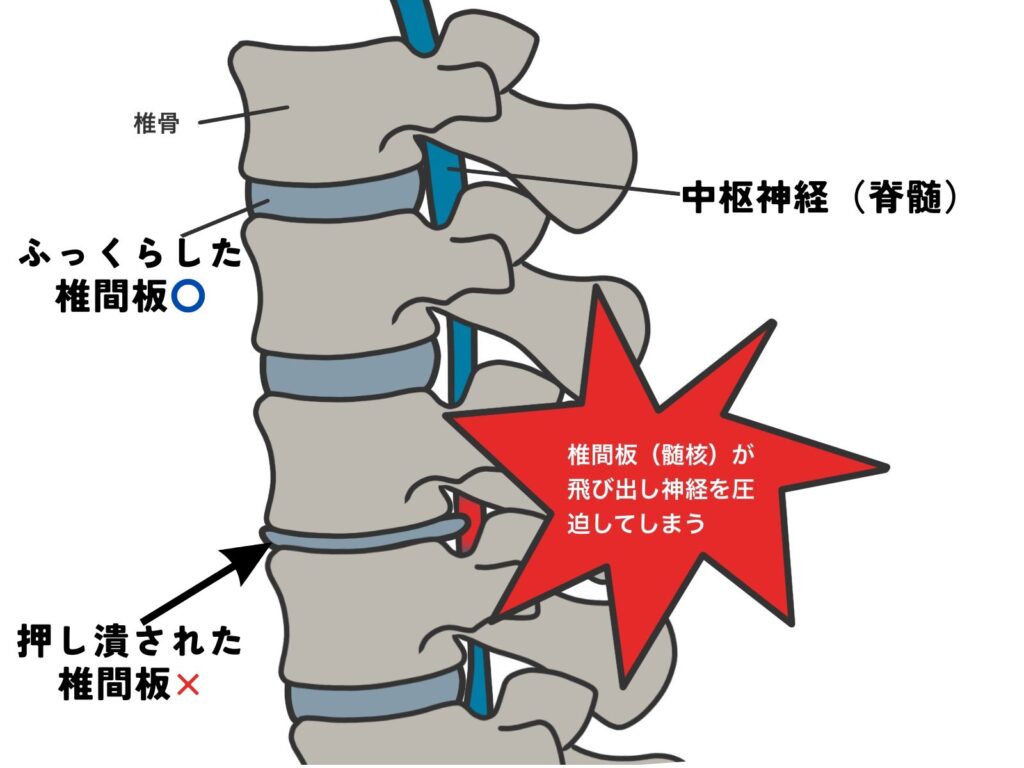 椎間板とヘルニアの説明